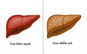 Gan nhiễm mỡ