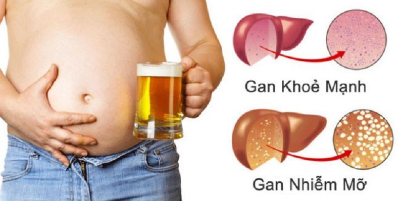 Gan nhiễm mỡ do bia rượu
