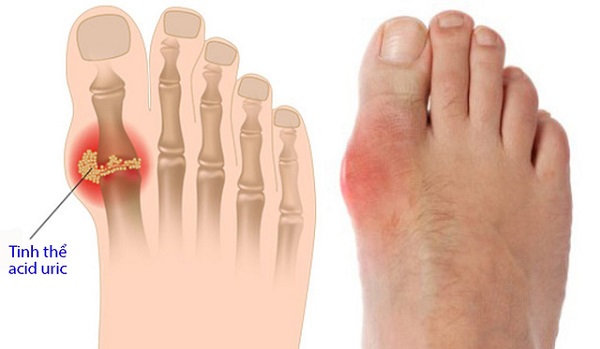 uống nước gì tốt cho bệnh gout