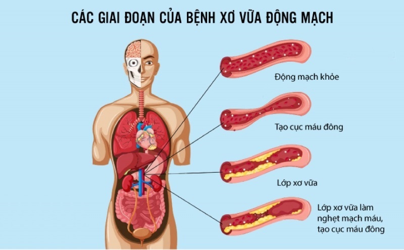 xơ vữa động mạch