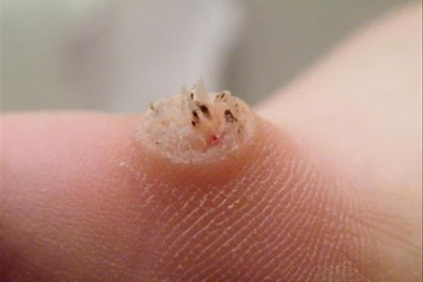 Trị mụn cơm bằng phương pháp dân gian đơn giản, dễ làm lại hiệu quả