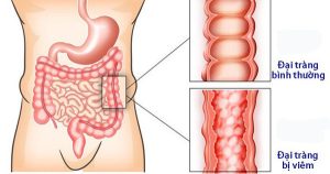 Bài thuốc bí truyền chữa viêm đại tràng mãn tính