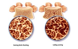 Làm thế nào để biết bạn đang thiếu canxi và khi nào cần bổ sung?