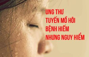 ung thư tuyến mồ hôi, bệnh hiếm nhưng nguy hiểm