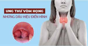 Triệu chứng của ung thư vòm họng