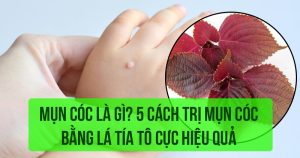 Mụn cóc là gì? 5 cách trị mụn cóc bằng lá tía tô cực hiệu quả