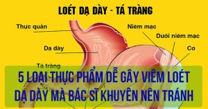 5 loại thực phẩm dễ gây viêm loét dạ dày mà bác sĩ khuyên nên tránh