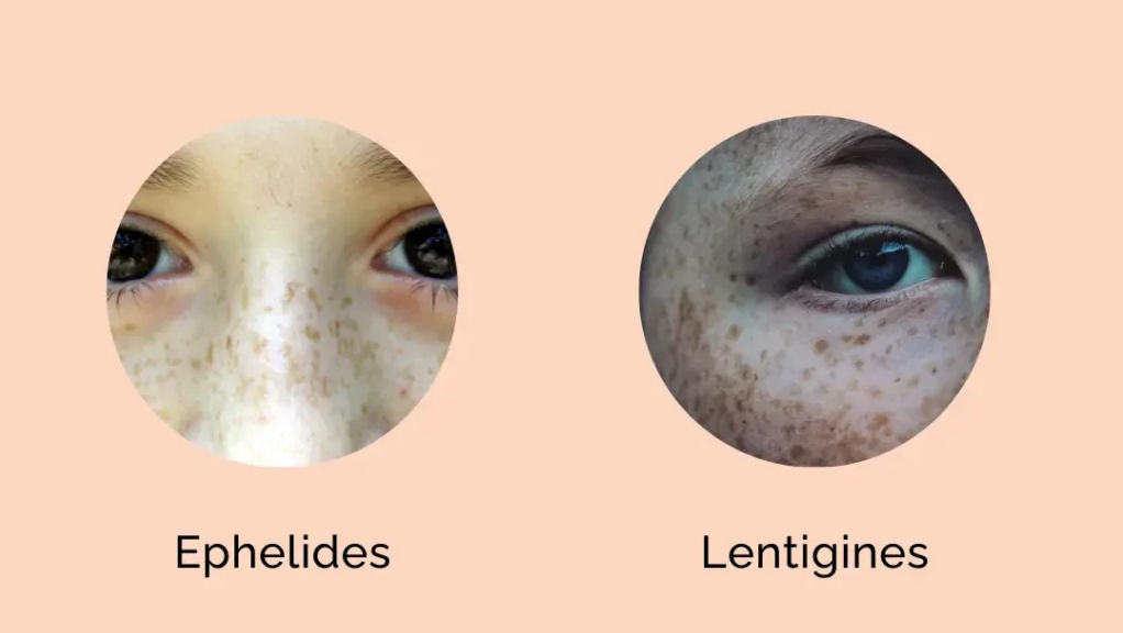 5 bài thuốc Đông y trị tàn nhang được bác sĩ khuyên dùng