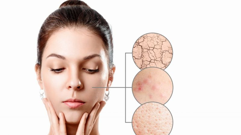 5 bài thuốc Đông y trị tàn nhang được bác sĩ khuyên dùng