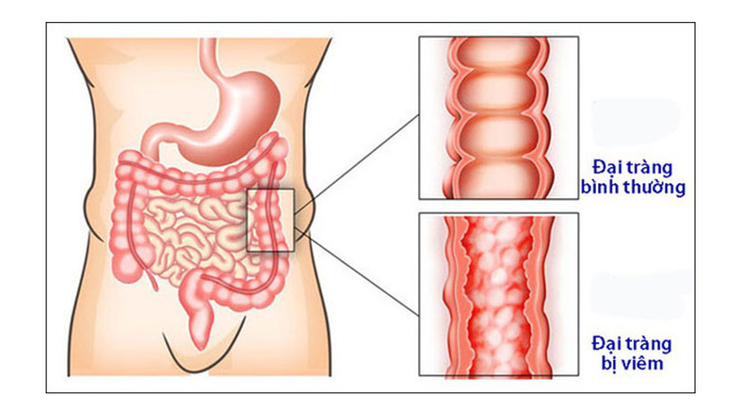 Bài thuốc quý chữa trị viêm đại tràng