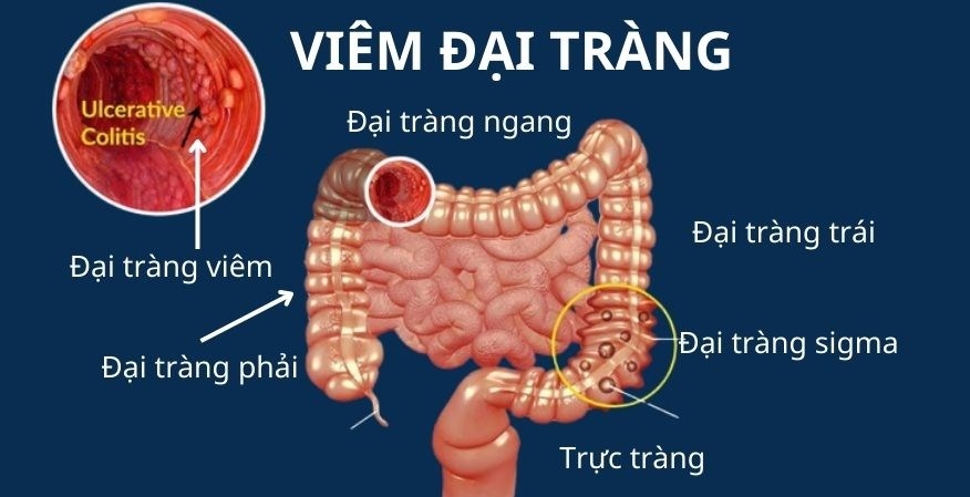 Bài thuốc quý chữa trị viêm đại tràng