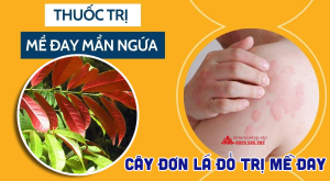 Bệnh mày đay, nguyên nhân, triệu chứng và cách trị