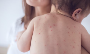 Cách trị bệnh sởi theo đông y cực hiệu quả