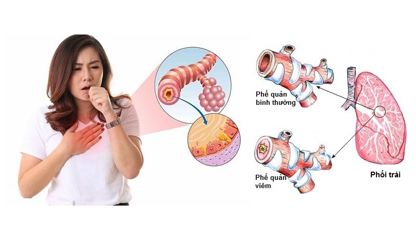 9 bài thuốc trị bệnh viêm phế quản cực hay