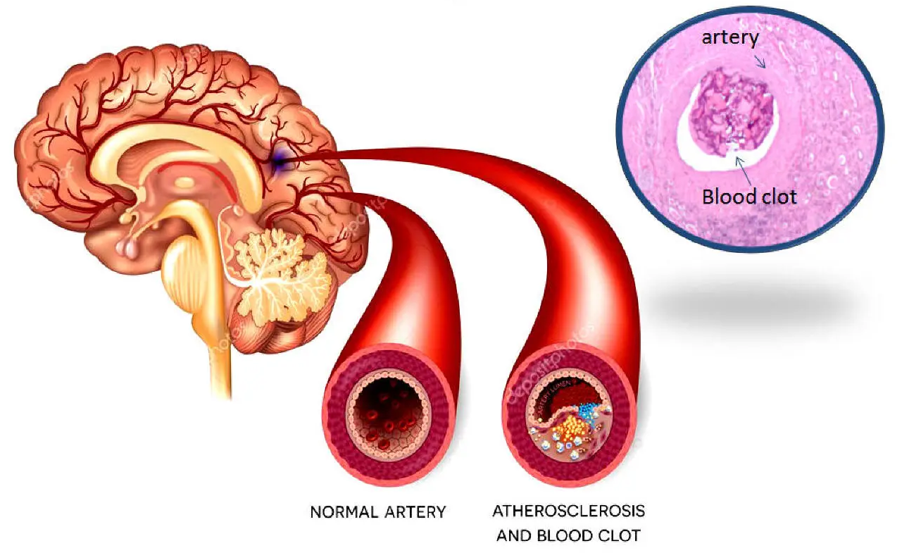 Bài thuốc Đông y trị thiểu năng tuần hoàn não