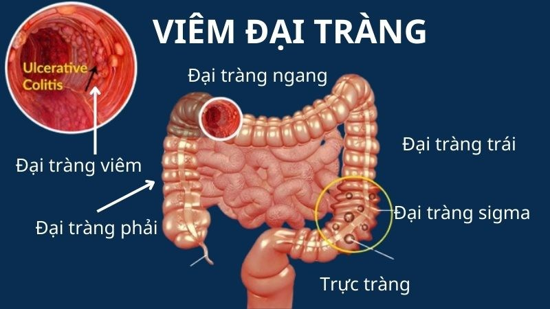 Bài thuốc trị bệnh viêm đại tràng mãn tính