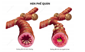 Bài thuốc trị hen phế quản cực nhạy