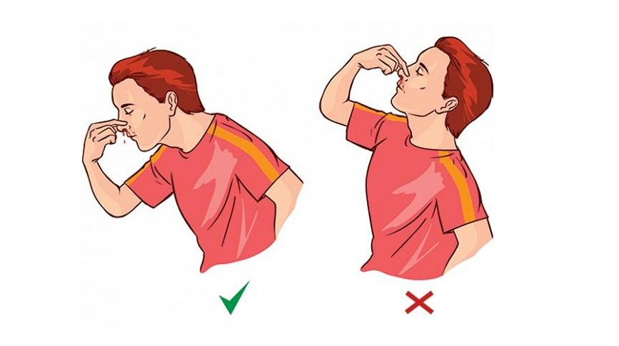 Bài thuốc chữa chảy máu cam