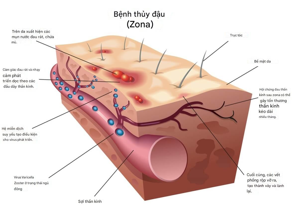 Bệnh thủy đậu, nguyên nhân, triệu chứng và bài thuốc