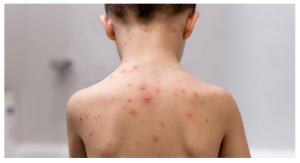 Bệnh thủy đậu, nguyên nhân, triệu chứng và bài thuốc