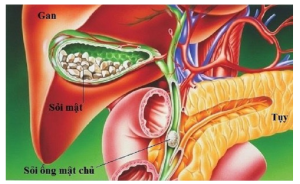 Sỏi mật, nguyên nhân, triệu chứng và bài thuốc đặc trị