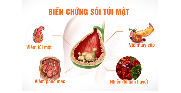 Sỏi mật, nguyên nhân, triệu chứng và bài thuốc đặc trị